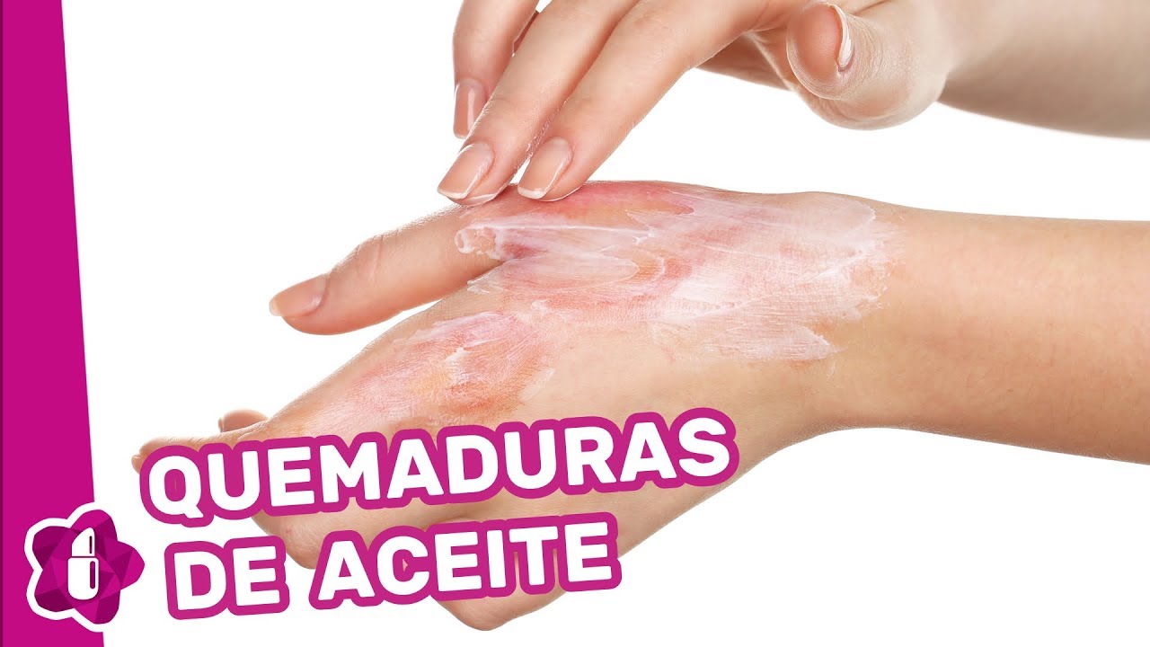 remedio casero para quemaduras de aceite