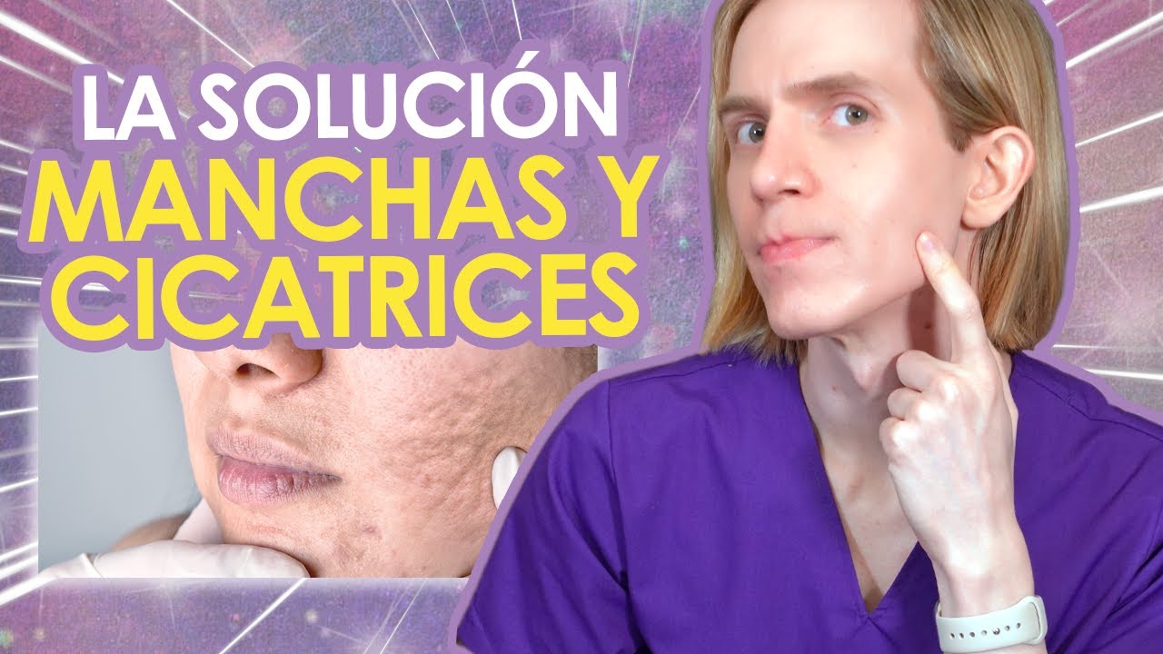 como quitar las manchas de acne