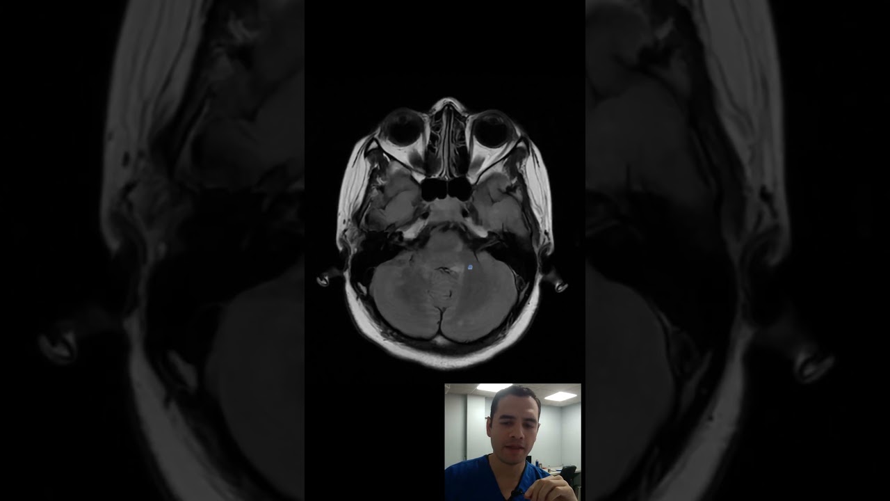 tipo de lesiones de esclerosis multiple en resonancia magnetica