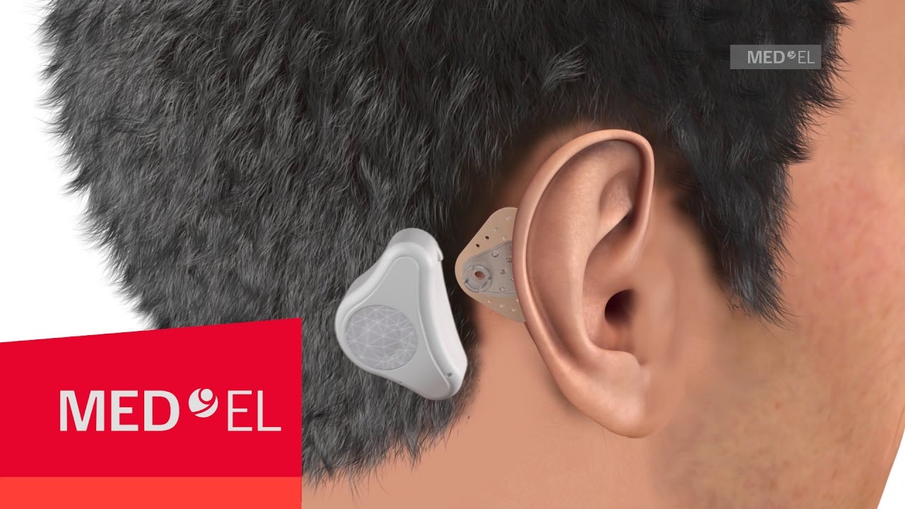auriculares de conducción ósea para sordos