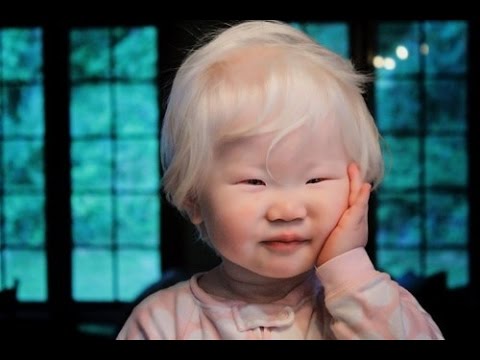 ausencia congénita total o parcial de melanina