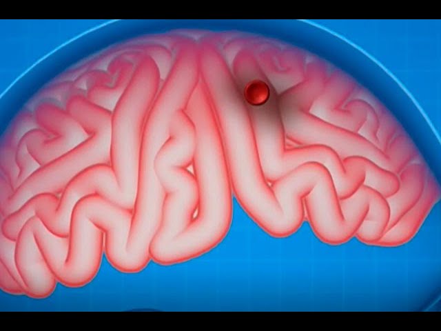 coagulos de sangre en el cerebro