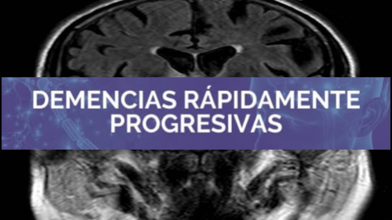 demencia rápidamente progresiva esperanza de vida