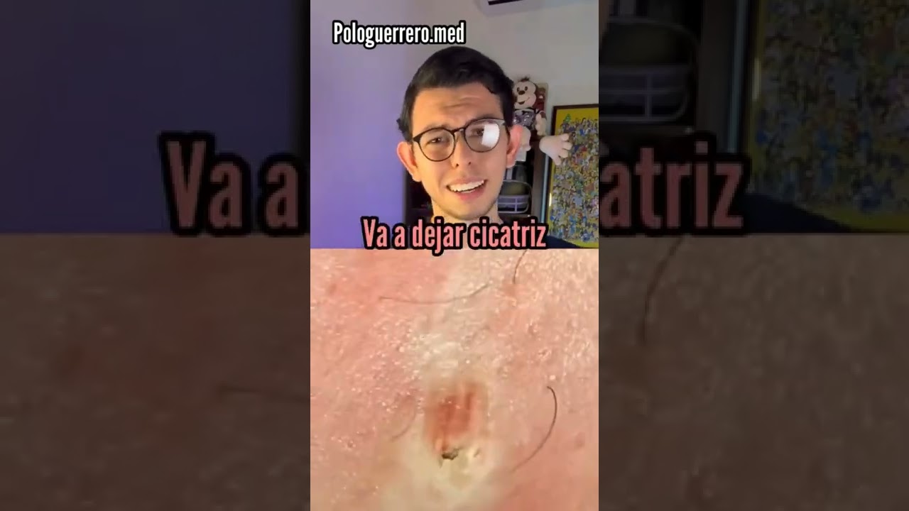 es bueno quitarse los puntos negros