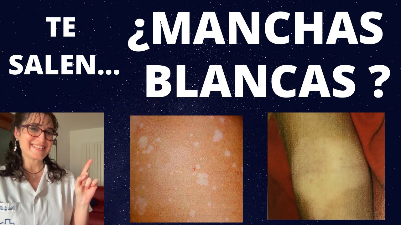 manchas blancas en la piel como quitarlas