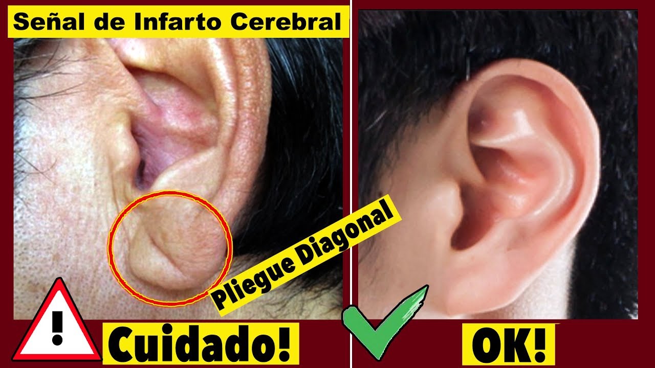 pliegue en el lóbulo de la oreja