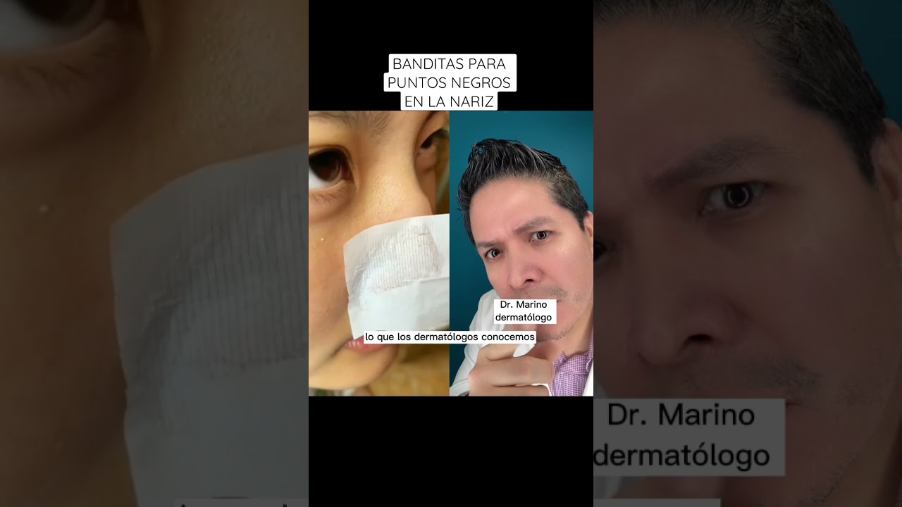 quitar puntos negros de la nariz rápido