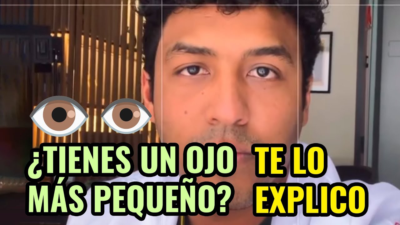 tener un ojo mas grande que el otro