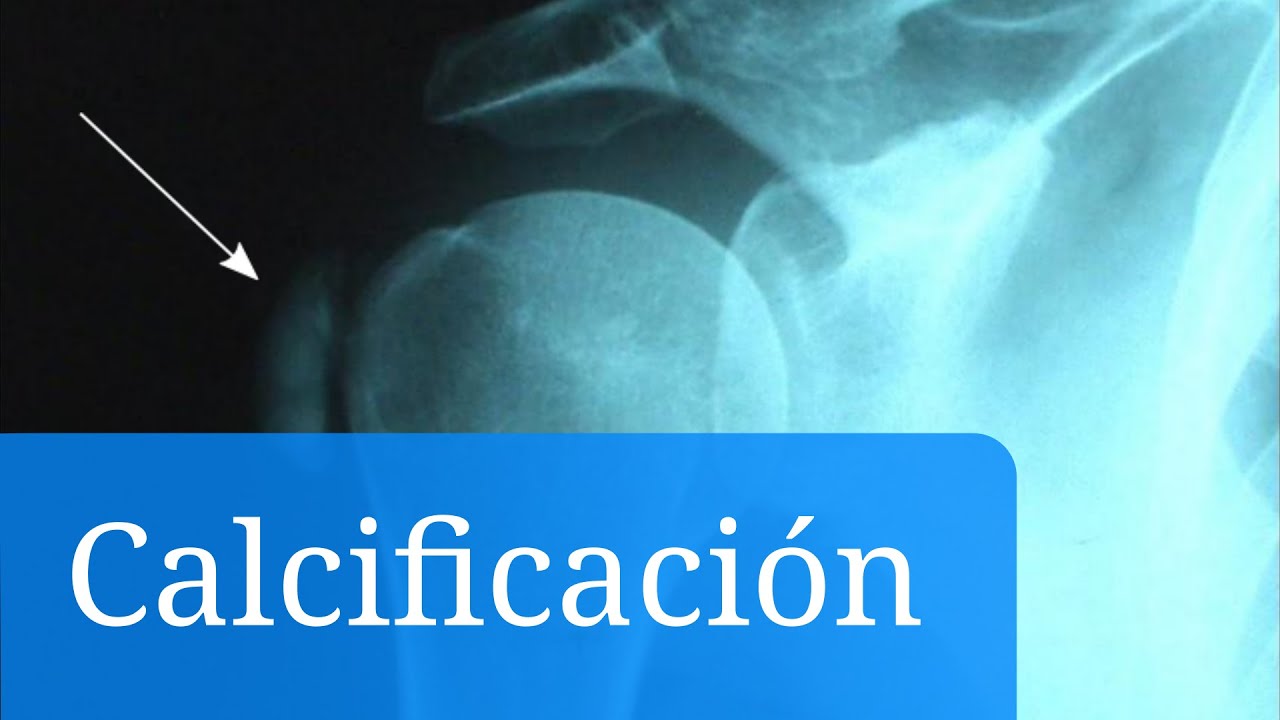como curar las calcificaciones en el cerebro