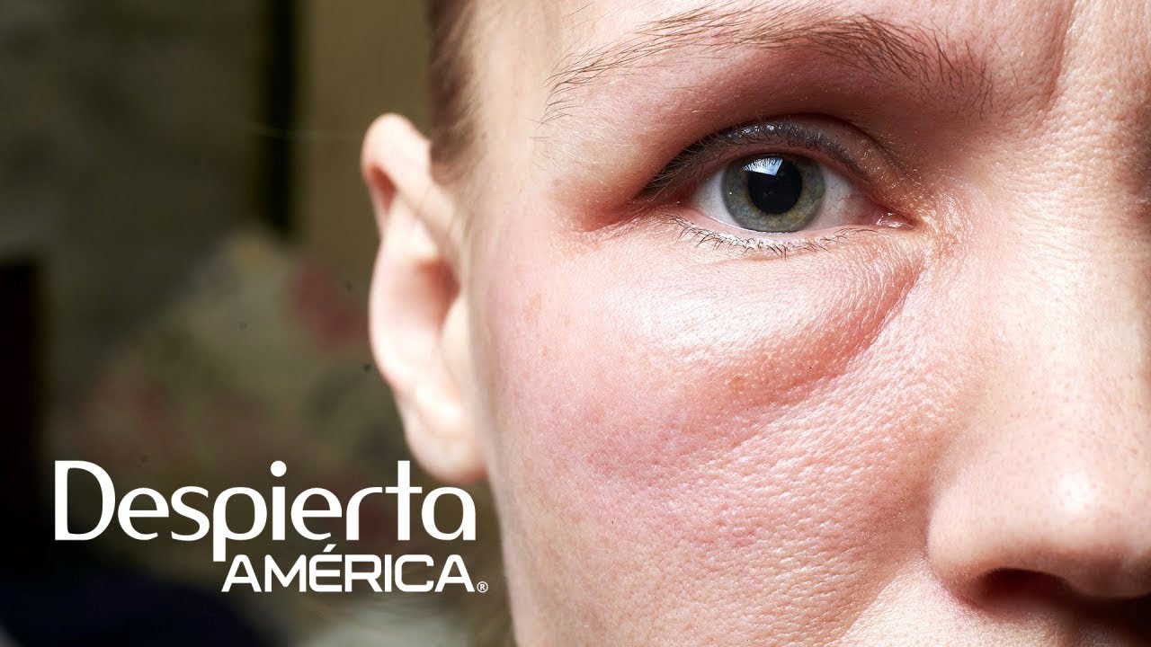 me he levantado con la cara hinchada