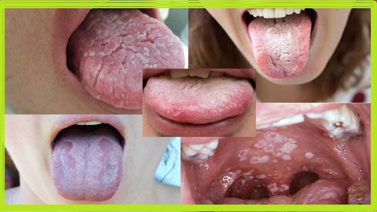 remedios caseros para la candidiasis bucal