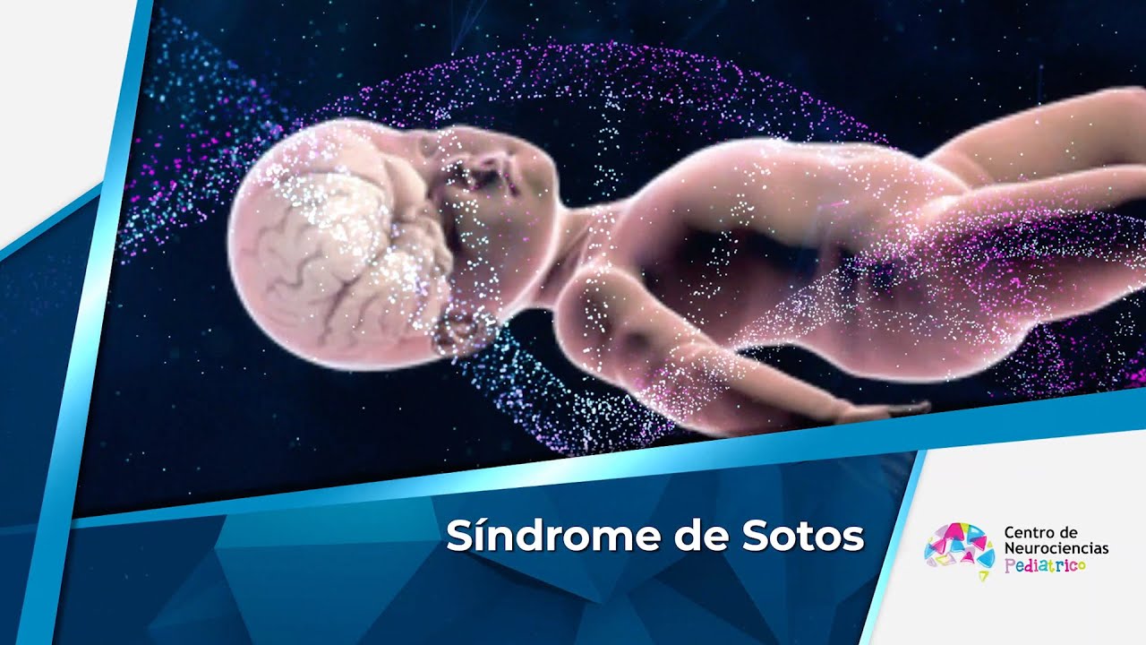 sindrome de sotos esperanza de vida