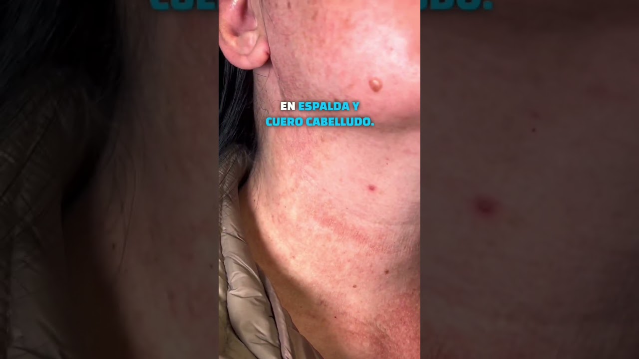manchas rojas en el cuello y escote